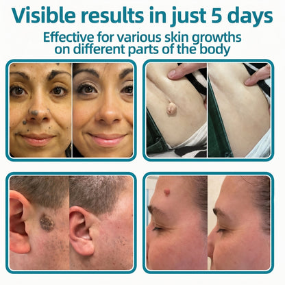 ✅🇺🇸𝐇𝐞𝒂𝒍𝗿𝗶𝙯𝙚®2-in-1 Microneedle & Hydrocolloid Patch🎀| Removes Raised Moles, Acne, Flat Warts & Skin Tags | Helps Improve Wrinkles, Scars & Blemishes | Invisible Patches for Face & Body