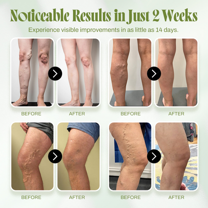 🍃Seurico™ Vein Relief Cream