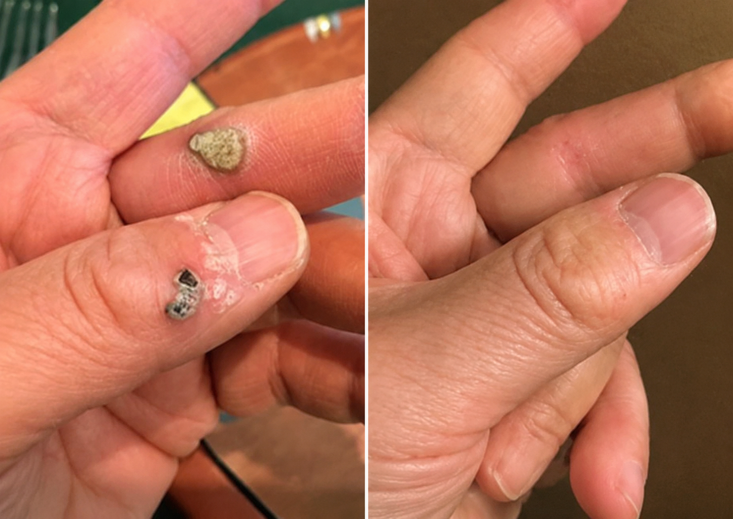 ✅🇺🇸𝐇𝐞𝒂𝒍𝗿𝗶𝙯𝙚®2-in-1 Microneedle & Hydrocolloid Patch🎀| Removes Raised Moles, Acne, Flat Warts & Skin Tags | Helps Improve Wrinkles, Scars & Blemishes | Invisible Patches for Face & Body