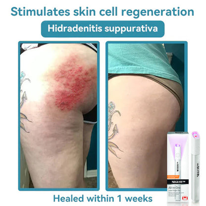 ✨NEGUSY™ All-in-One CO₂ Laser Eraser Pen | Removes Moles, Warts, Skin Flaws & Pigmentation