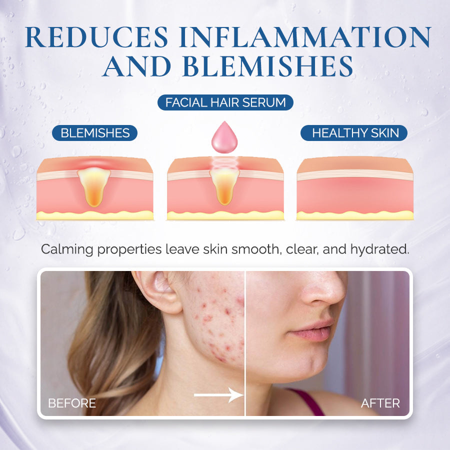 PCOS Facial Hair Natural Treatment At Home