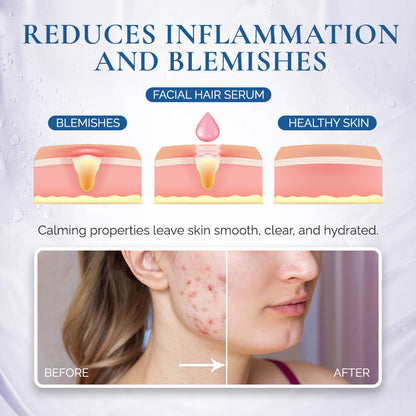 PCOS Facial Hair Natural Treatment At Home