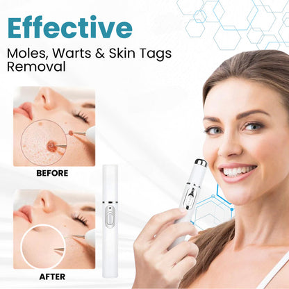 ✨Seurico™ Laser Pen - Non-invasive Mole and Wart Removal