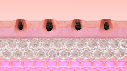 PCOS Facial Hair Natural Treatment At Home